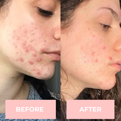 Lux Cove High Frequency Therapy Wand