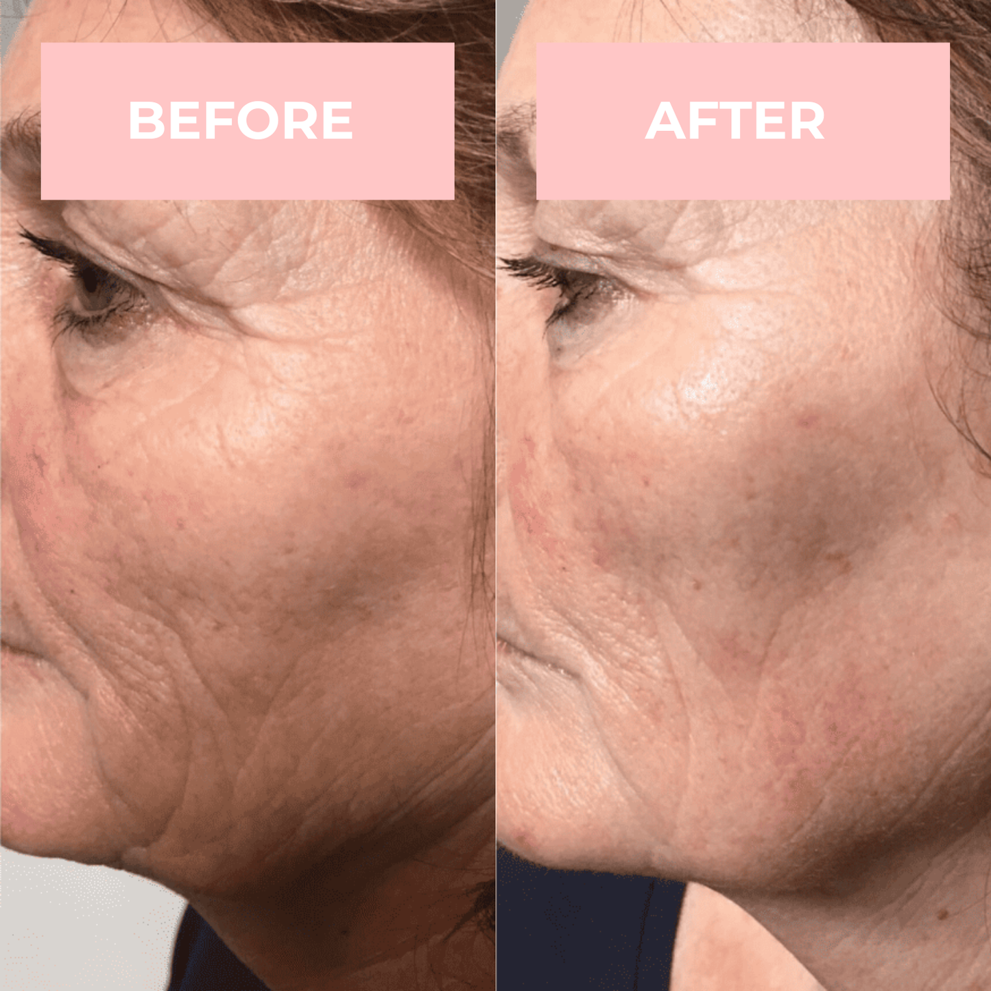 Lux Cove High Frequency Therapy Wand