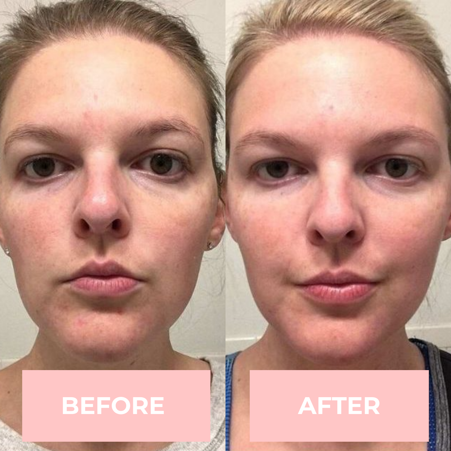 Lux Cove LED Face Mask