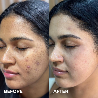 Alpha Arbutin + TXA Cream