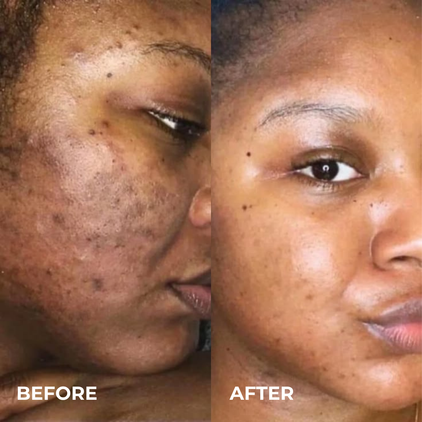Alpha Arbutin + TXA Cream