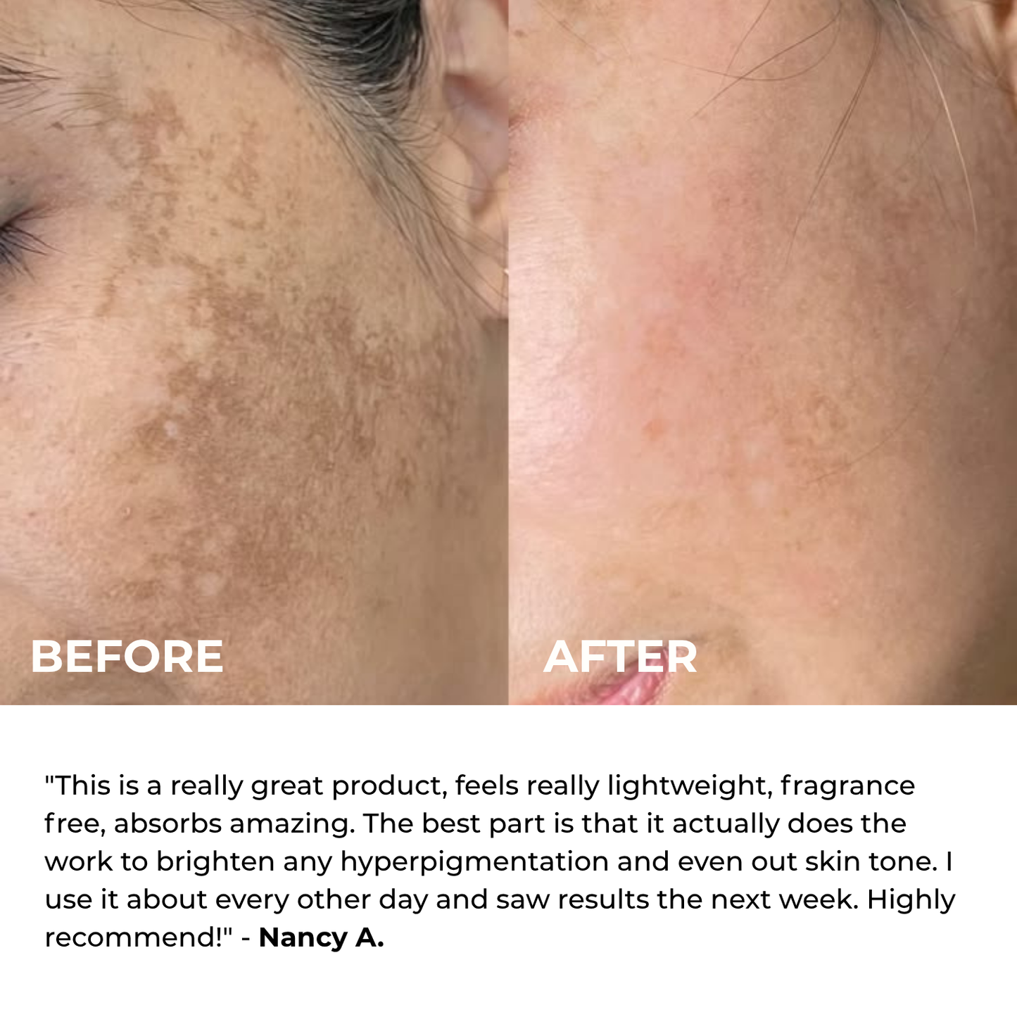 Alpha Arbutin + TXA Cream