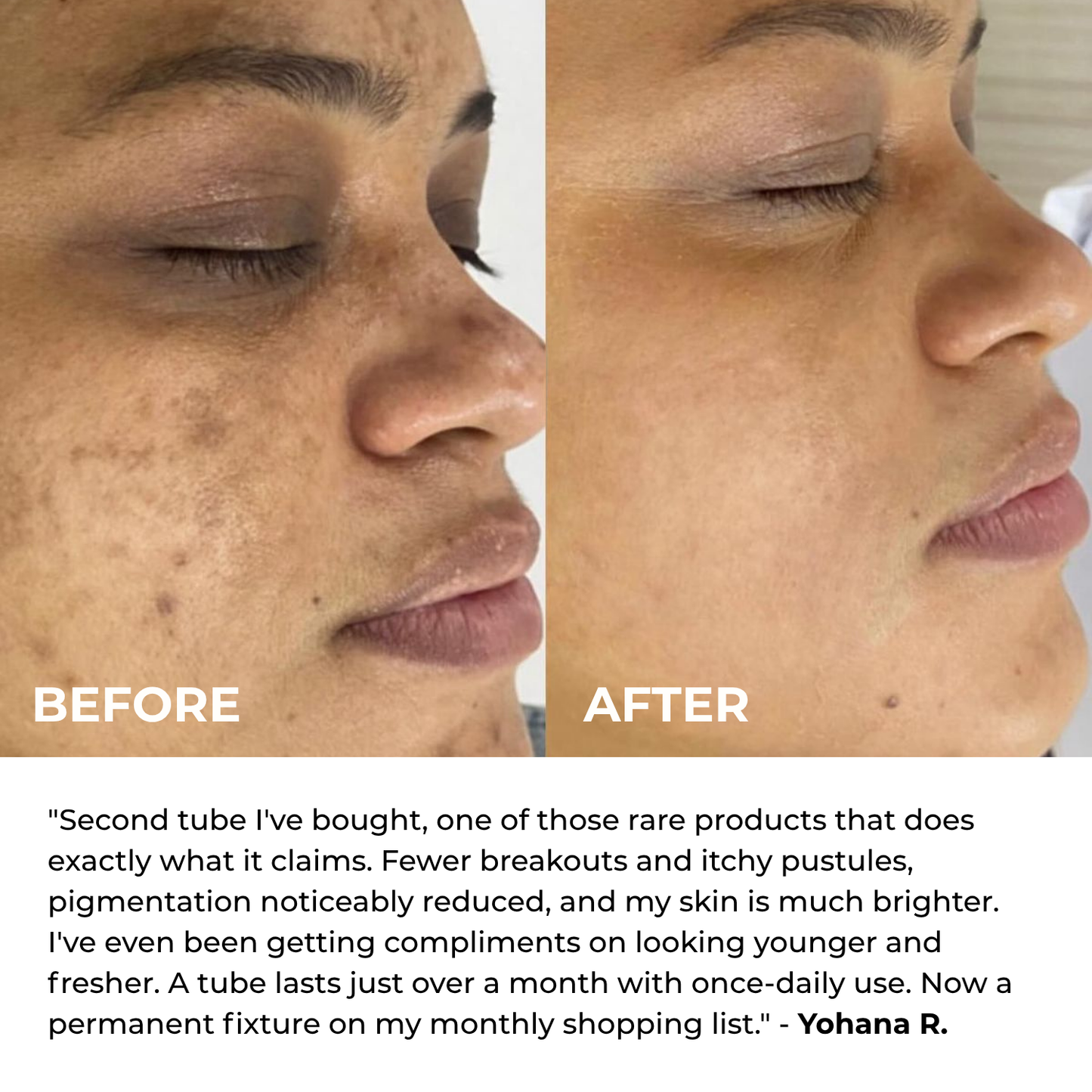 Alpha Arbutin + TXA Cream